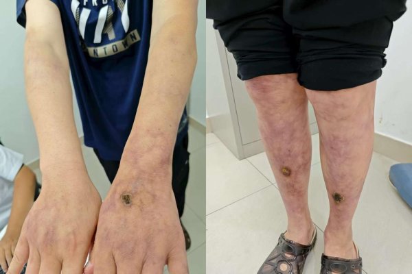 配资知识股 山东60岁大爷皮肤结了“蜘蛛网”？涂平教授为患者拨开病症迷雾