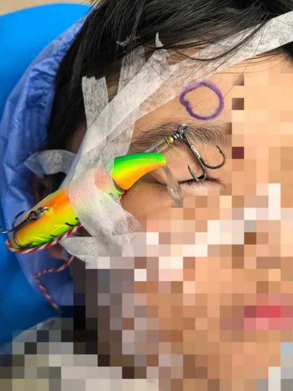 正规实盘配资平台 鱼钩刺穿眼球，济南市眼科医院成功解救八岁男孩
